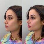 A ex-BBB e empresária Bianca Andrade, também conhecida como Boca Rosa, realizou uma harmonização facial. Com a técnica, a artista mudou o nariz e fez preenchimento nos lábios. (Foto: Instagram)