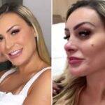 Andressa Urach harmonizou seu rosto, fazendo pequenas alterações no maxilar e preenchendo os lábios. (Foto: Instagram)