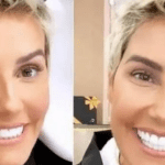 Em entrevista, ela contou que, após realizar a harmonização facial, refletiu sobre a pressão estética que sofria e optou por voltar atrás. (Fotos: Instagram/Montagem)