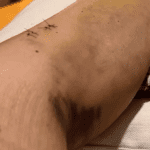 A apresentadora exibiu os hematomas e pontos que recebeu após ter um acidente enquanto esquiava com os filhos. (Foto: Instagram)