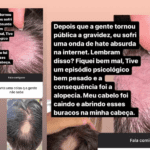 Eliezer surpreende ao falar sobre Alopecia. (Fotos: Instagram/Montagem)