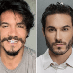 O ex-BBB já fez rinoplastia, tratamento ortodôntico, harmonização facial e implante de barba e cabelo. (Foto: Instagram)