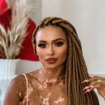 Em entrevista ao Sensacional (RedeTV!), Natália Deodato contou que ficou em depressão profunda na fase de surgimento de seu vitiligo (Foto: Instagram)