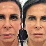 Bem resolvida, Gretchen não esconde os procedimentos estéticos que realiza. Na foto acima, é possível ver seu antes e depois de passar por uma harmonização facial - tratamento que ela já retocou algumas vezes. (Fotos: Instagram/Montagem)