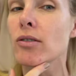 Ana Hickmann é outra que também já enfrentou problema com acne. (Foto: Reprodução/Instagram)