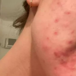 Alice Wegmann já enfrentou problema com acne. (Foto: Reprodução)