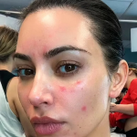 Em 2023, Kim Kardashian contou sobre uma condição inflamatória que sofre na pele, a acne adulta. (Foto: Instagram)