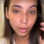 Vanessa Lopes mostra seu rosto com acne e faz desabafo (Foto: Instagram)