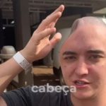 Devido ao acidente, parte de seu crânio precisou ser temporariamente armazenada em seu abdômen. (Foto: TikTok)