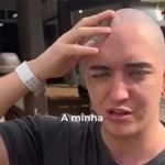 Para aliviar a pressão no cérebro, foi realizada uma craniotomia descompressiva, removendo parte do osso craniano, conhecido como "calota craniana." (Foto: TikTok)