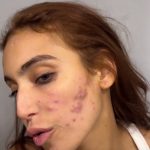 A influenciadora digital Vanessa Lopes usou suas redes sociais para mostrar aos seguidores como está sua pele após uma crise de acne (Foto: Instagram)