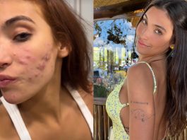 Vanessa Lopes faz desabafo sobre rosto cheio de acnes (Foto: Instagram)