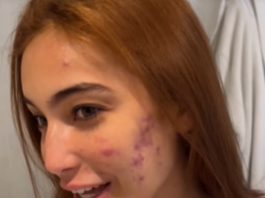 Vaness Lopes mostra estado das suas acnes (Foto: Instagram)