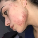 Flávia já mostrou seu rosto com espinhas inflamadas e desmistificou essa pressão estética em torno das pessoas que tem acnes. (Foto: Instagram)