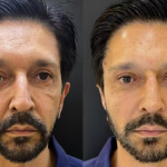 Ricardo Nunes, de 56 anos de idade, realizou uma harmonização facial com Karim Salman, na JK Estética Avançada, em São Paulo. (Fotos: Divulgação/JK Estética/Instagram)