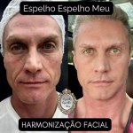 Aos 52 anos, o ator André Segatti realizou uma harmonização. (Foto: Reprodução/Instagram)