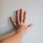 De acordo com a Sociedade Brasileira de Dermatologia (SBD), fatores emocionais, genéticos e imunológicos podem influenciar seu desenvolvimento. (Foto: Unsplash)