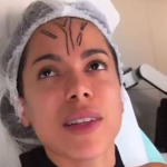 Anitta realizou um procedimento estético para remover a veia saltada de sua testa. A cantora compartilhou nas redes sociais registros do antes e depois da cirurgia, mas o que chamou atenção e viralizou não foi o procedimento em si, e sim as cenas divertidas da artista ainda sob o efeito da anestesia. (Foto: Reprodução/Instagram)