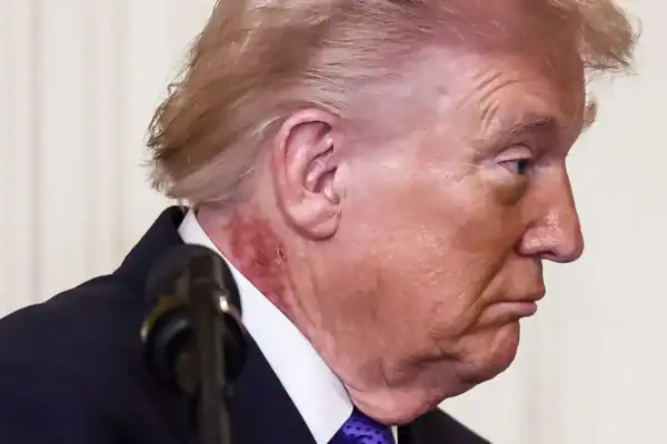 Saúde de Donald Trump volta ao centro das atenções após cerimônia na Casa Branca